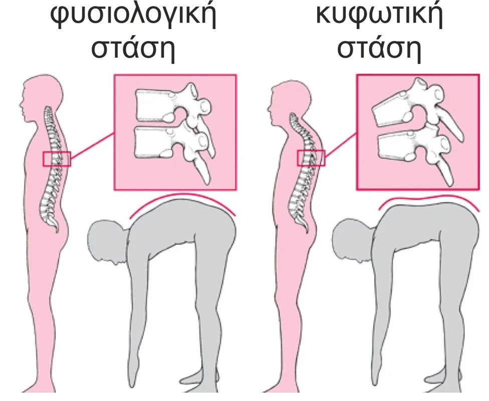 Κύφωση