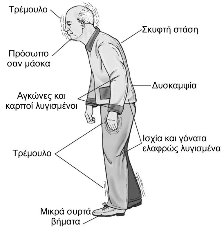 Νόσος Parkinson συμπτώματα