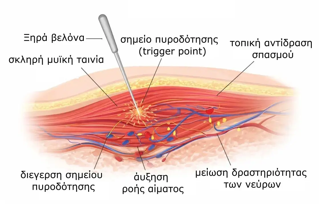 Βελονισμός 2 Μηχανισμός δράσης ξηράς βελόνας σε σημείο πυροδότησης (trigger point) - αύξηση ροής αίματος και μείωση νευρικής δραστηριότητας