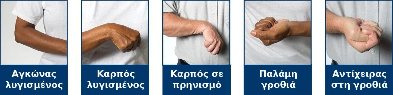 Μέθοδος Bobath Concept 2 Θέσεις σπαστικότητας άνω άκρου σε ημιπληγικό ασθενή μετά από εγκεφαλικό